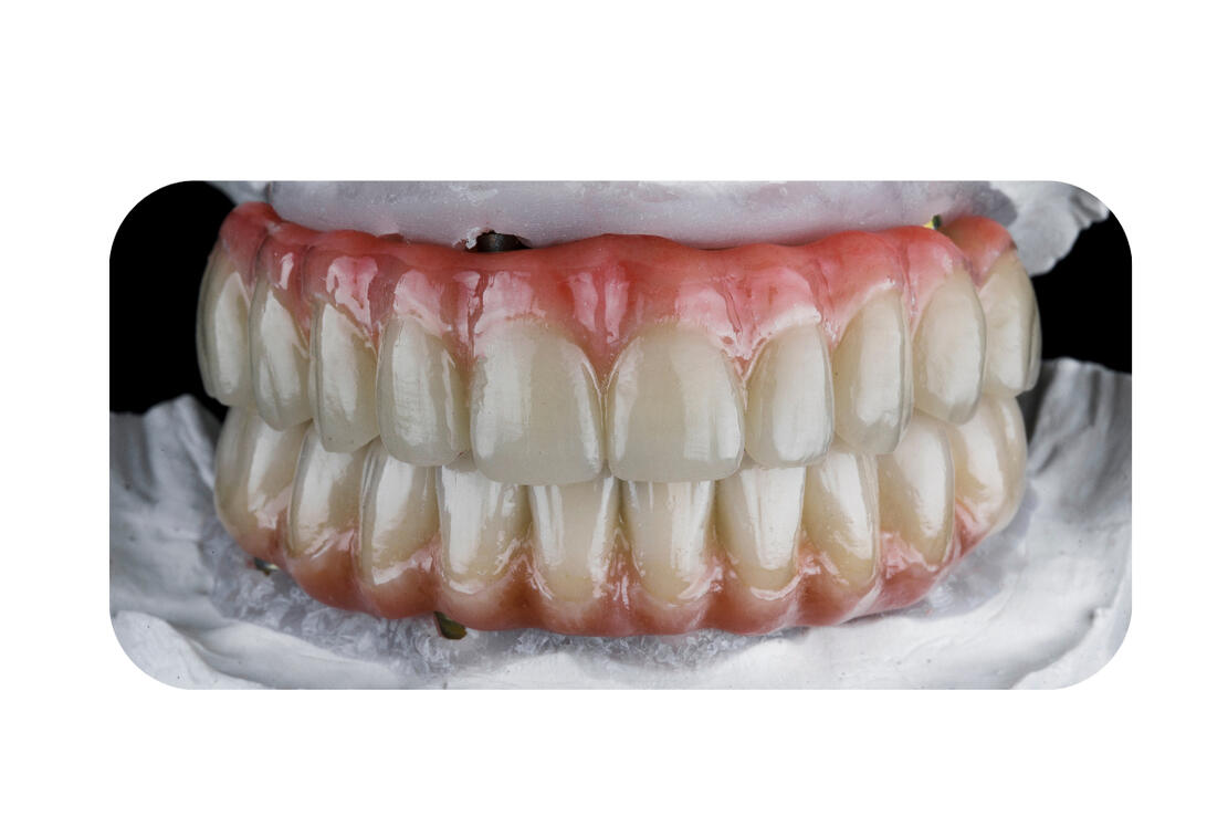 Възстановяване на липсващи зъби