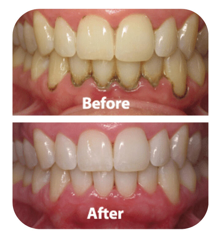 Почистване на зъбен камък