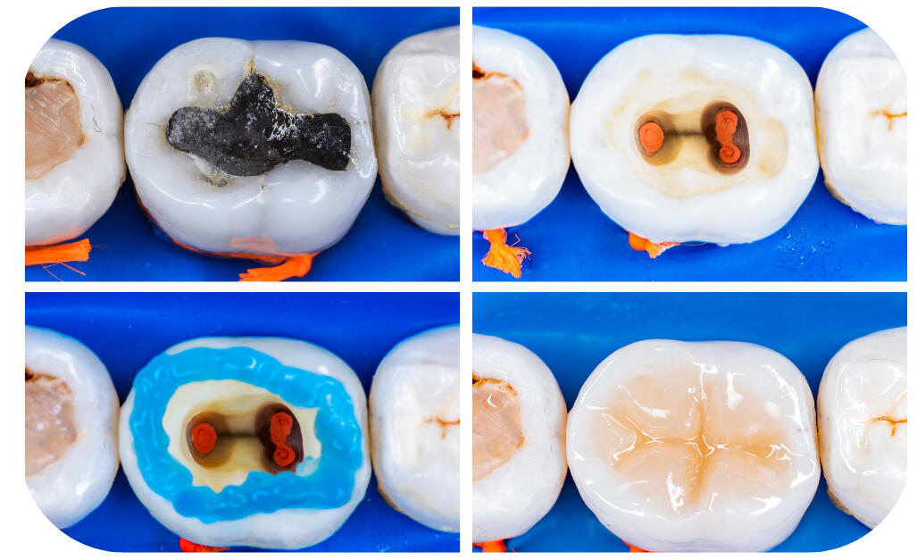 лечение на възпалени зъби