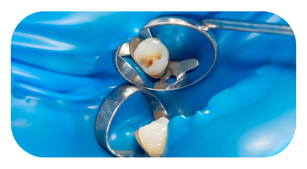 Лечение на кариес