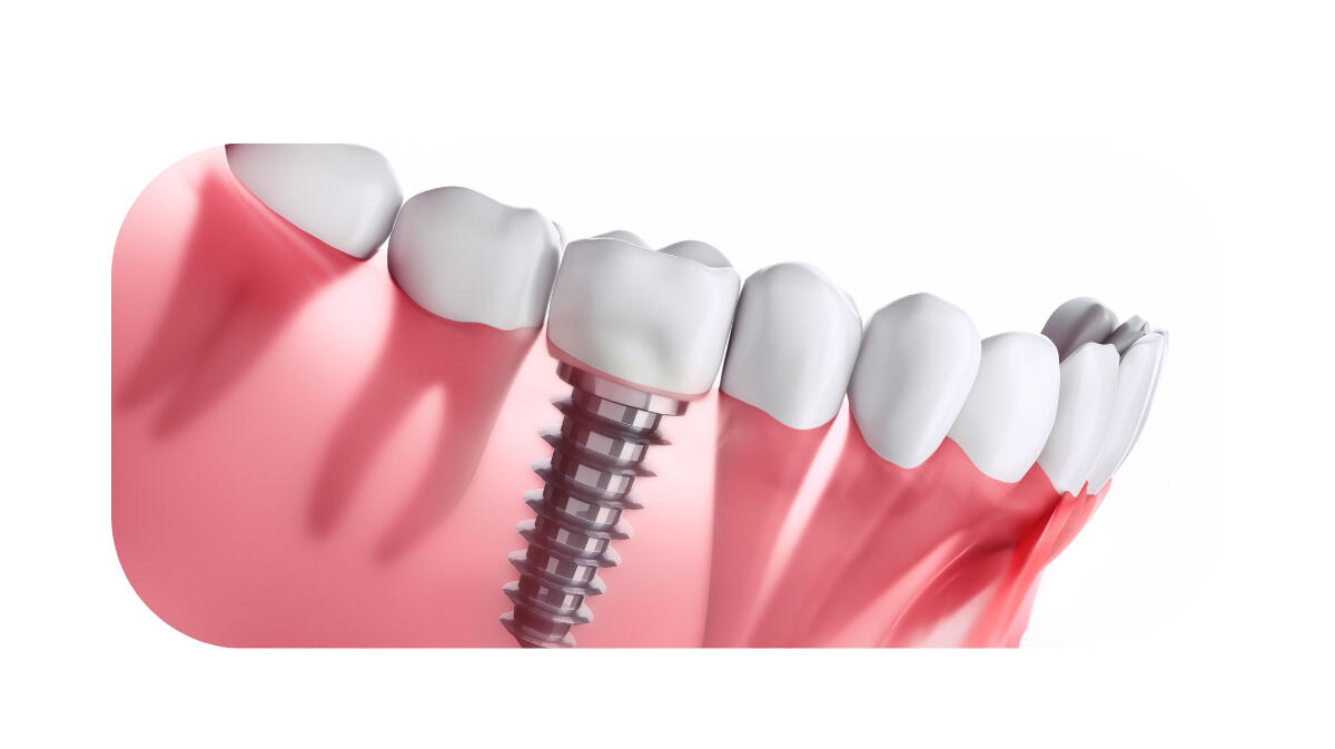 Дентални импланти