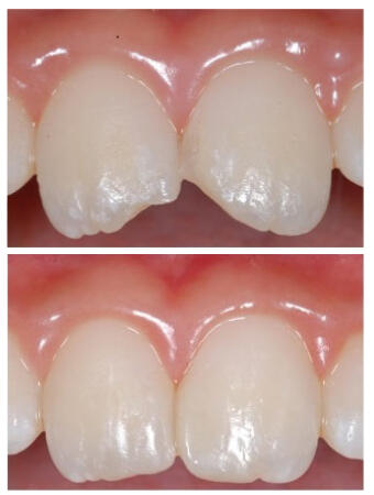 Before after